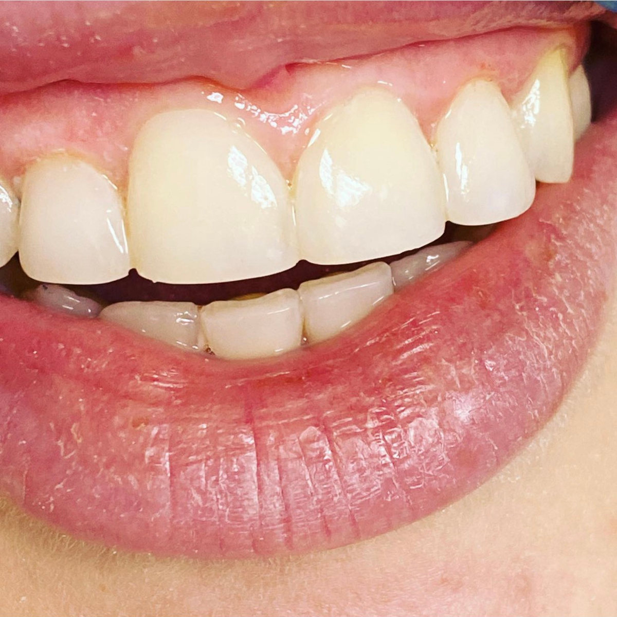 Косметическая реставрация 4-х зубов - закрытие 3-х зубов и диастемы