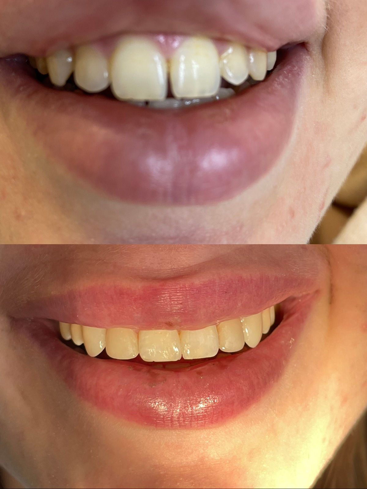 реставрация 4-х передних зубов фотополимером до и после  Киев 0521