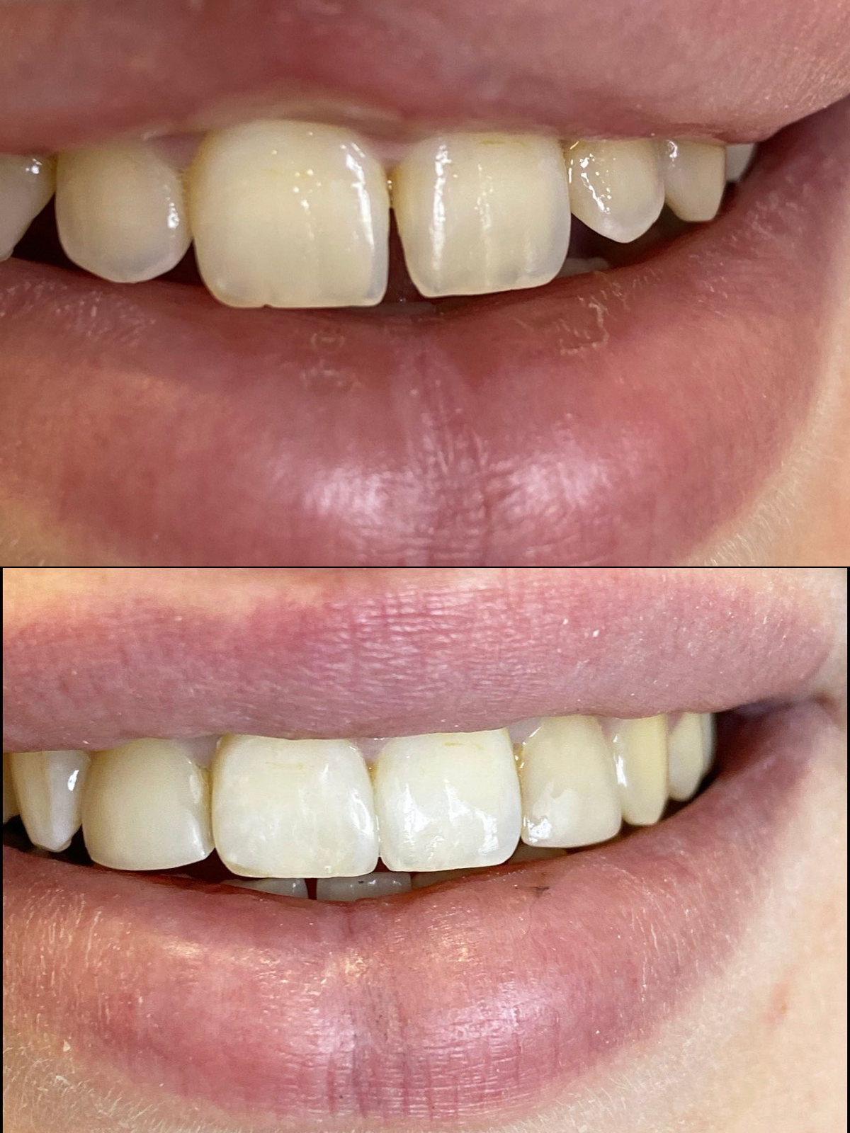 реставрация передних зубов фотополимером киев до и после